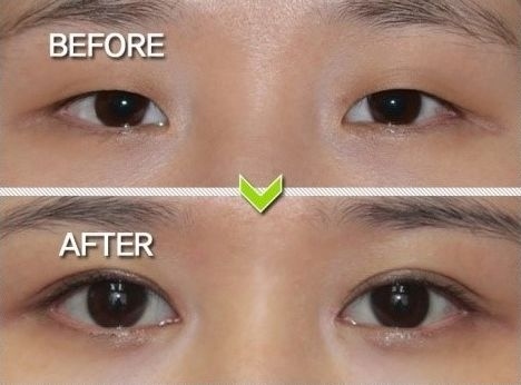 ٣١ صورة مجنونة لكوريين قبل و بعد عمليات التجميل